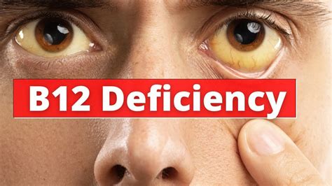 Causes Diagnosis And Treatment Of Vitamin B12 Deficiency Doctor Explains Youtube