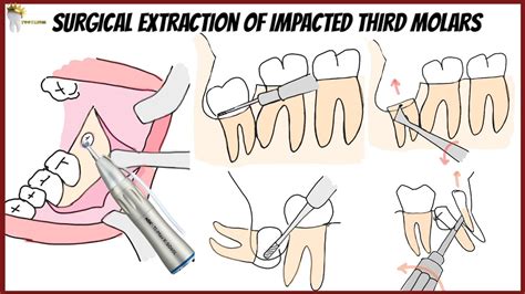 Surgical Extraction Of Impacted Mandibular Third Molars Horizontal