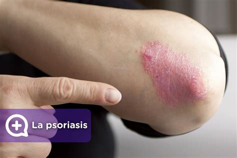 Romano Brumoso Haz Un Esfuerzo Tratamiento Para La Psoriasis En Las