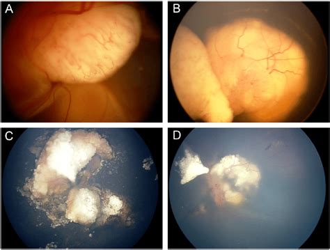 Case Fundus Photographs At The First Visit Before Treatment Of