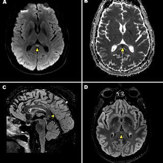 A B Axial Dwi Mri Image A And Adc Map B Show An Ovoid Focal