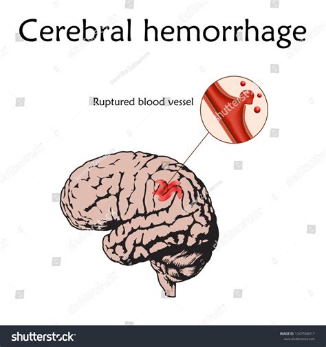 Cerebral Hemorrhage Poster Banner Vector Medical Stock Vector Royalty