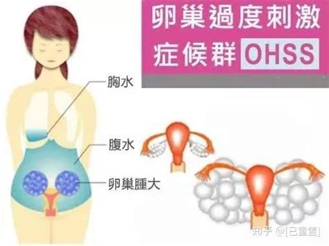 【错误案例】乱打绒促性素导致卵巢过度刺激综合症 知乎