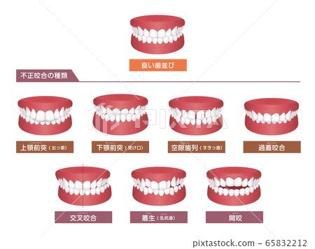 Types Of Malocclusion