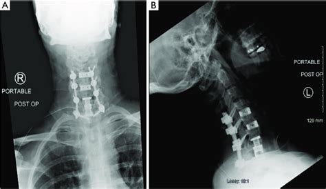 Ap A And Lateral B Postoperative Cervical Spine Radiographs