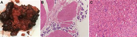 Nodular Oncocytic Hyperplasia Of Bilateral Parotid Glands With