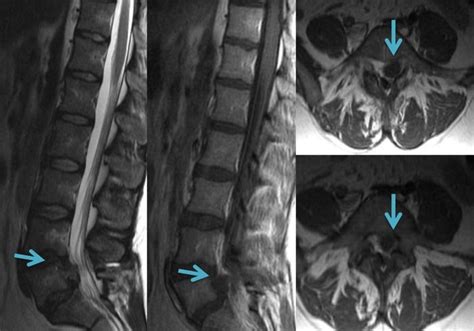 La Resonancia Magnética Lumbar Una Prueba Indolora Y Muy Segura