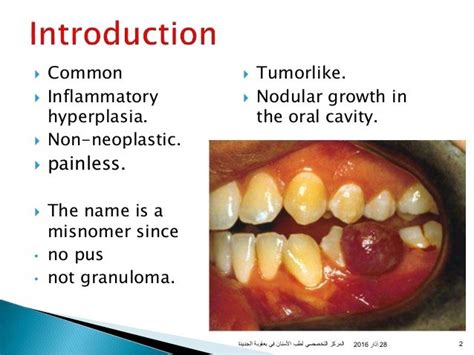 Oral Pyogenic Granuloma