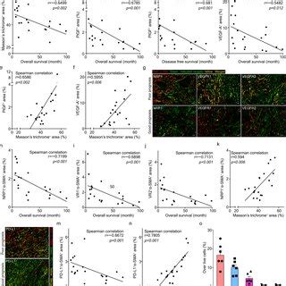 Pdac Patients With Poor Prognosis Have Elevated Levels Of Intratumoral