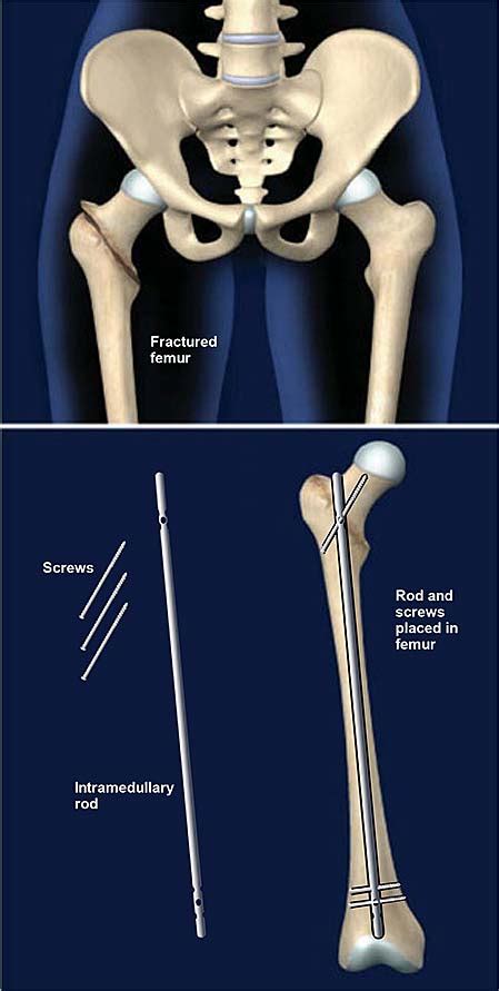 Femur Fracture Fixation with Intramedullary Rod | Central Coast ...