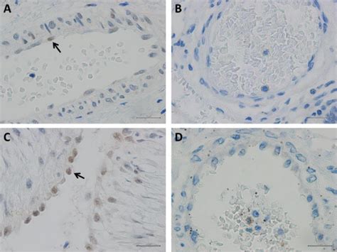 Scielo Brasil Possible Association Between A Polymorphism Of Epas1 Gene And Persistent