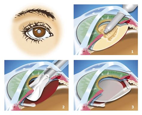 Les Implants Intraoculaires Ophtalmologie Manosque Dr Gonzalvez Et