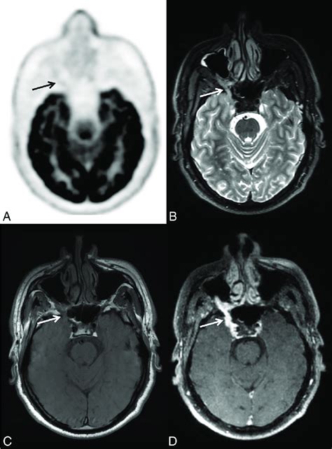 Initial Staging Of Right Adenoid Cystic Carcinoma Of A Minor Salivary