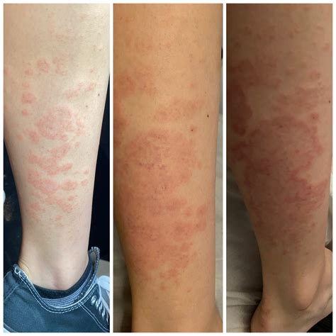 Granitos Rojos Con Picor En Las Piernas Dermatologo Net