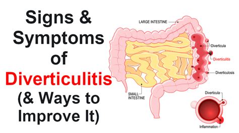 Symptoms Of Diverticulitis Mistery Maven