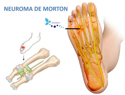 crecer Tutor Activar neuroma de morton en el pie Juramento violación