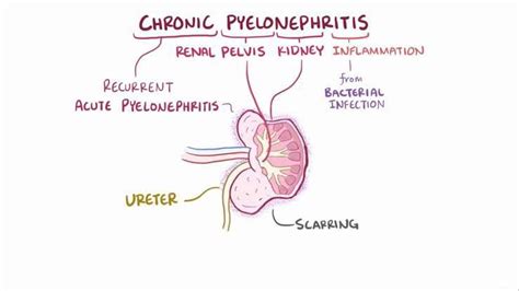 Chronic Pyelonephritis Medizzy