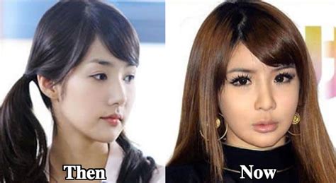 Park Bom Plastic Surgery Before and After Photos