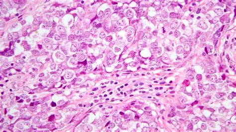 Thymic Carcinoma Review And Update