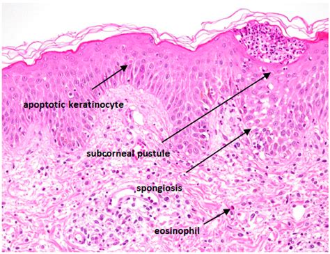 Acute Generalized Exanthematous Pustulosis Histology