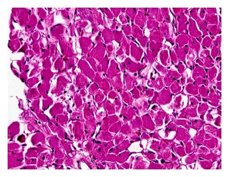 Rhabdomyoma A Low Power View Of The Rhabdomyoma Left With Adjacent