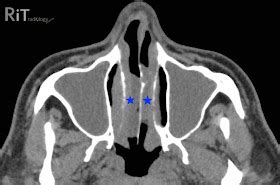 RiT radiology: Sinonasal Polyposis