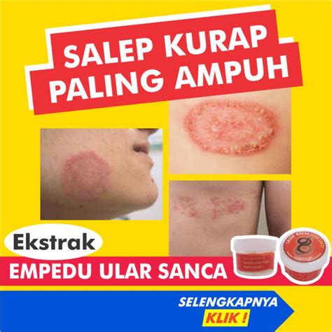 Jual Salep Obat Kurap Kudis Paling Ampuh Gatal Kulit Gatel Kadas Eksim