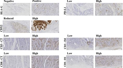 Immunohistochemical Staining For HLA G PD L1 CDX2 CD3 And CD8