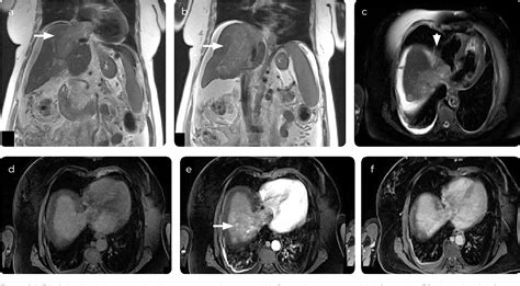 Figure 1 From Magnetic Resonance Imaging Of The Diffuse Hepatocellular Carcinoma Two Case