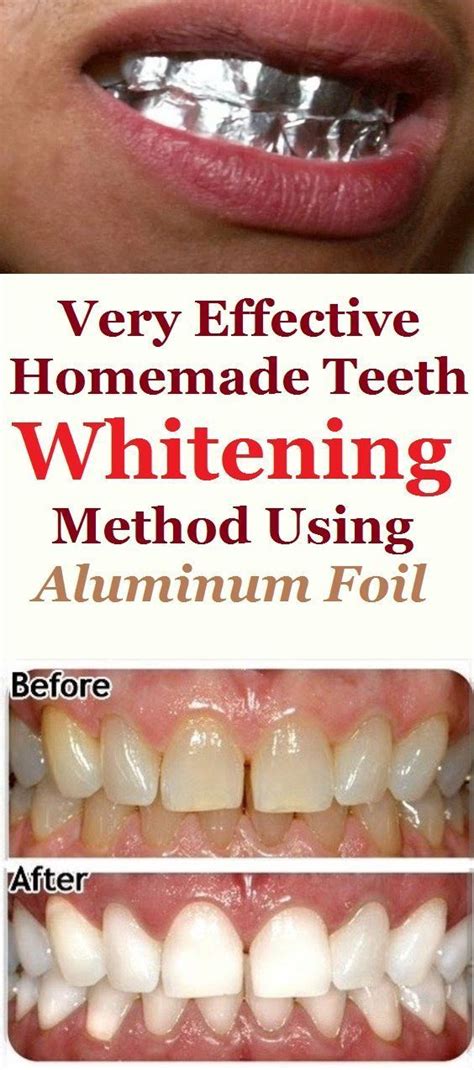 Pin On Homemade Teeth Whitening