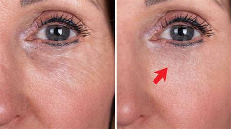 Rejuvenece Tu Contorno De Ojos Sin B Tox Trucos Infalibles Para Una