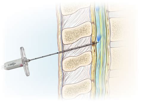 Spinal Epidural Combined Anesthesia Kits