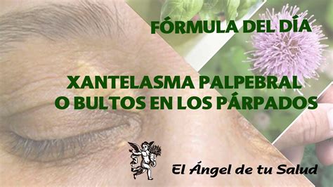 F Rmula Herbolaria Para Tratar Xantelasma Palpebral O Bultos En Los