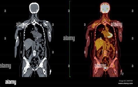 Pet Ct Scan Fusion Image It Provides Detailed Images By Merging