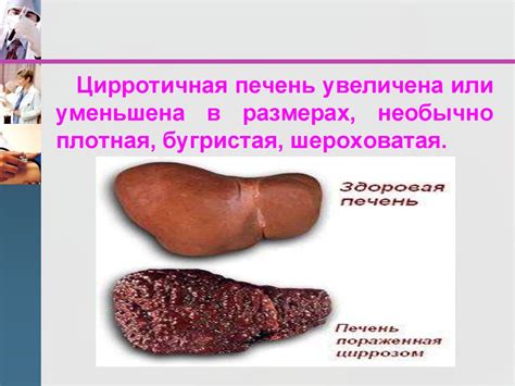 Цирроз печени - презентация онлайн