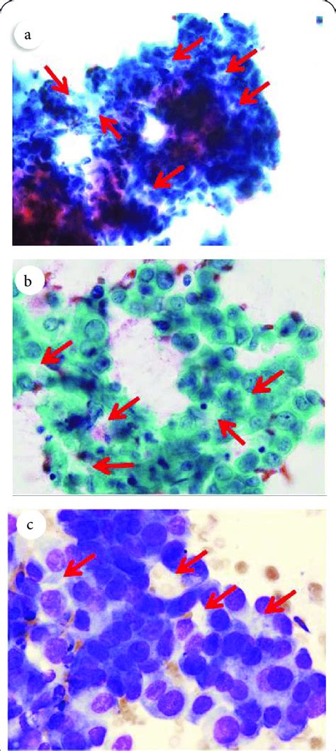 Representative Features Of Fine Needle Aspiration Cytology A A Sheet