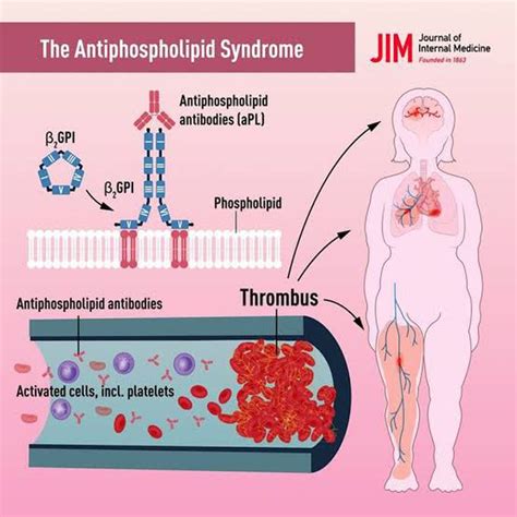 Antiphospholipid Syndrome MEDizzy