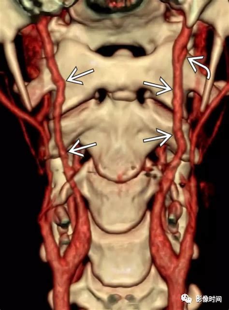 颈动脉间隙解剖与其常见的 12 种疾病影像表现 丁香园