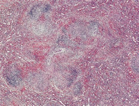 Hodgkin S Lymphoma Of The Spleen Light Micrograph Stock Image C