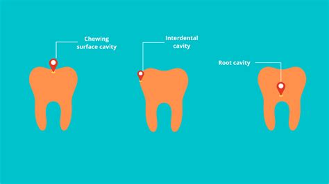 What You Need To Know About The 3 Main Types Of Tooth Decay