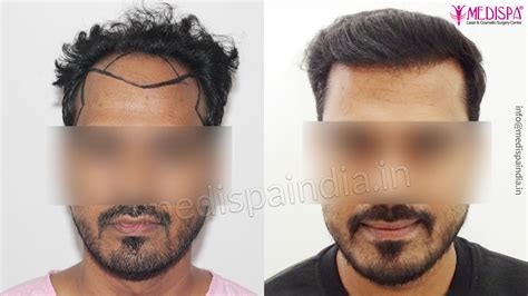 Hair Transplant Ghaziabad Results Hair Transplant Dubai Cost