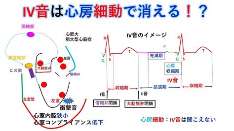 国試対策 暗記からの卒業 90話 Iii音・iv音 Youtube