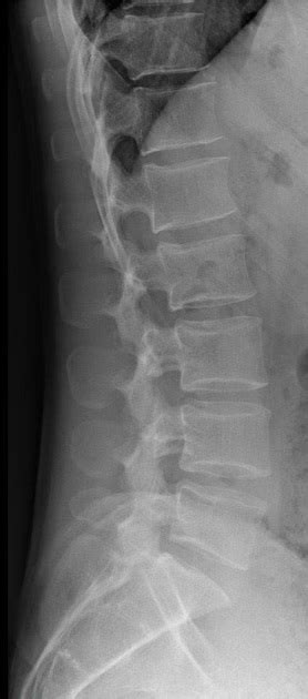 Lumbar Vertebrae Lateral View