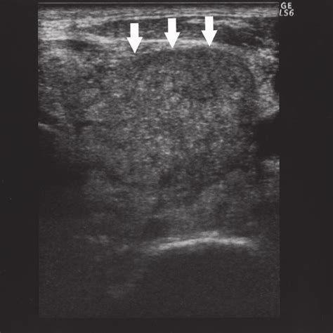 Ultrasonographic Findings Of The Thyroid Tumor Ultrasonography Reveals