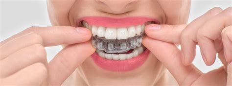 EASY PLACEMENT OF ATTACHMENT | PRISTINE CLEAR ALIGNERS