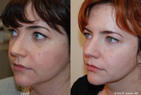 Eric M Joseph Md Permanent Non Surgical Rhinoplasty Nose Job