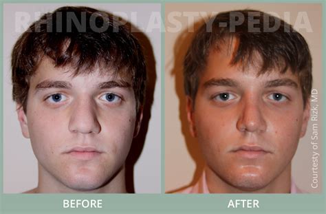 View NYC Male Rhinoplasty Patients Before And After Photos