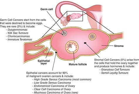 Ovarian Neoplasms Clinical Tree