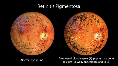 Qué es la retinitis o retinosis pigmentaria Síntomas y causas