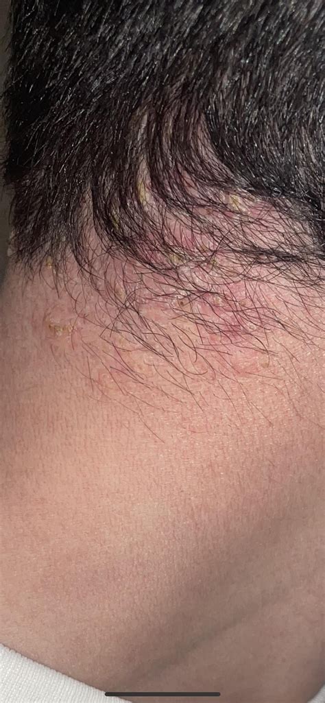 Bacterial Or Fungal Rfolliculitis